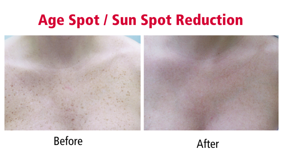 Laser Pigmentation Treatment Overview Spa Olivia Laser Hair Removal